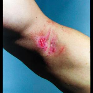 Hi-Tech Wound Hi-Tech Wound